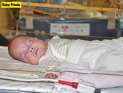 Premature Baby Frieda Mangold