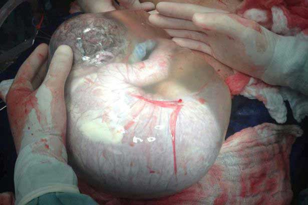 Baby-born-inside-amniotic-sac
